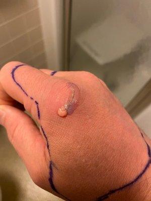 My second day in the hospital.  The infection broke through the liquid stitches.