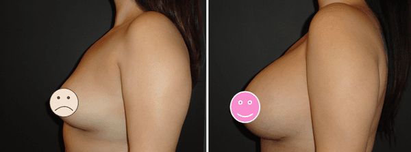 Dr. DeVito Breast Augmentation Before and After