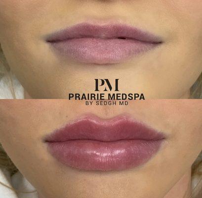 Lip enhancement at Prairie Medical Spa