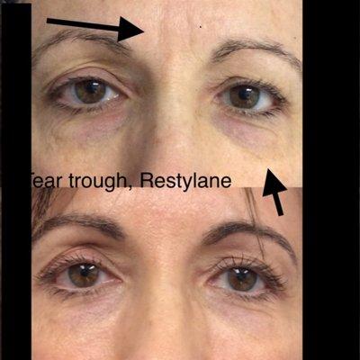 under eye Restaylne. Botox to the frown area.