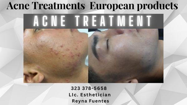 Acne Treatment fast healing in three days