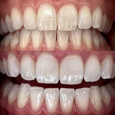 Laser teeth whitening