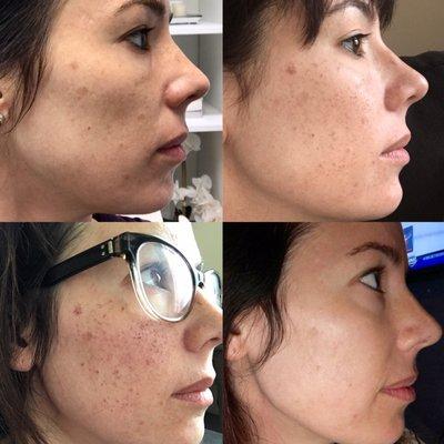 Progression photos of 1 IPL treatment.  Before, 2 hours post, 3 days post, 6 weeks post. I'm thrilled it's amazing!