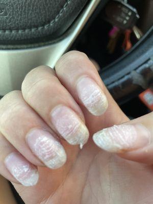 ripped nails