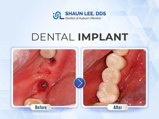 Shaun Lee, DDS Family Emergency Dental Implants of Renton | 10700 SE 174th Street, Suite 204, Renton, WA