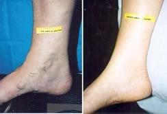 Foot vein treatment before & after