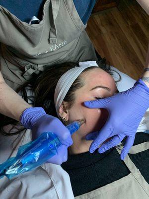 Microneedling Treatment to stimulate collagen production.