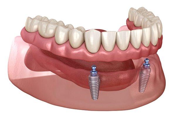 Snap In-2 Denture
$6,999