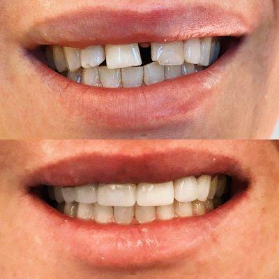 Porcelain veneers and crowns to close gaps, correct bite, and achieve aesthetic smile.