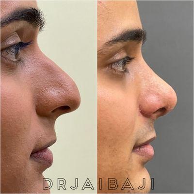 Rhinoplasty