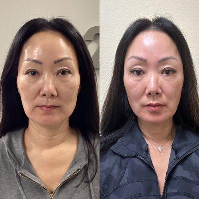 Before (left pic) and After (right pic) Emface ... after 4 treatments