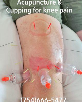 Cupping and Acupuncture for knee pain.