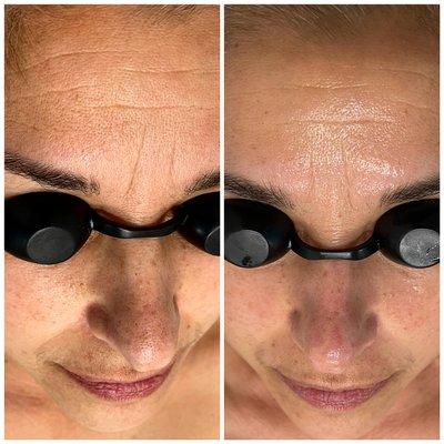 Left side is before treatment 
Right side is after a lactic peel