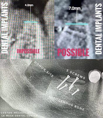 Horisontal Bone Grafting for Dental Implants