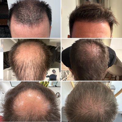 6 month post op. Primary focus on crown with secondary focus on hairline. 3,150 grafts containing 9,219 hairs.