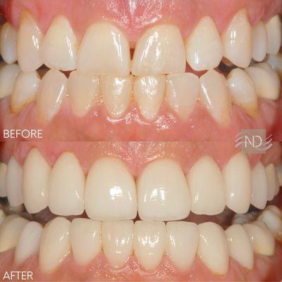 Smile makeover