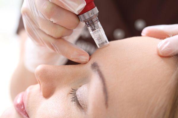 Micro-needling is a collagen-stimulating treatment great for general skin rejuvenation! Check out our website at www.aleamedspa.com