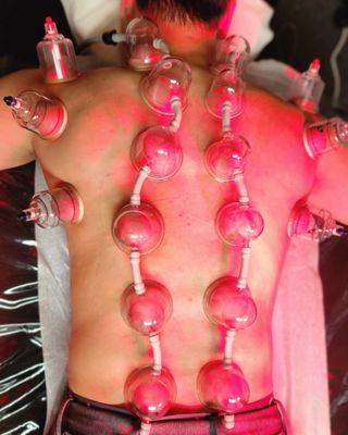 Cupping Therapy