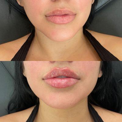 Lip filler