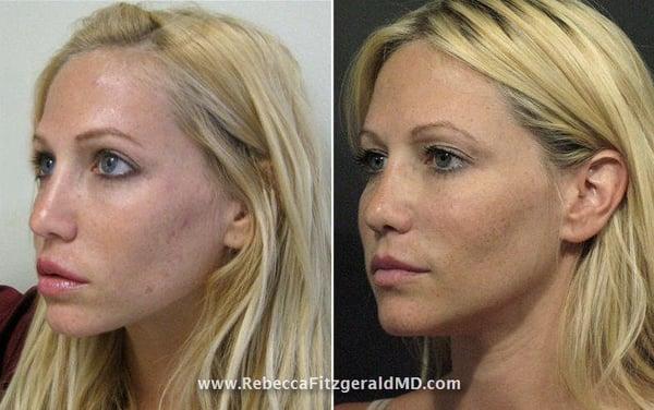 Dr. Fitzgerald uses a combination of techniques using Sculptra, Restylane, and Botox to achieve a desired look.