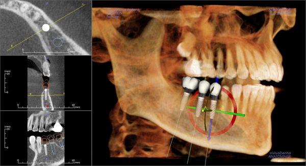 Surgically guided implants are placed within 0.5mm precision.