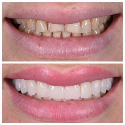 Porcelain Veneers makeover