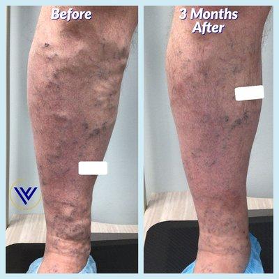 Before And After Varicose Vein Treatment