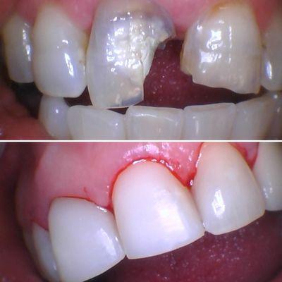 Badly damage tooth  
 Look at this masterpiece . Fixed with composite Veneers  to give this wonderful patient a bright and beautiful smile.