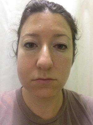 My face for TWO WEEKS after getting a cavity filled. It looks terrible, but it felt worse than it looked!