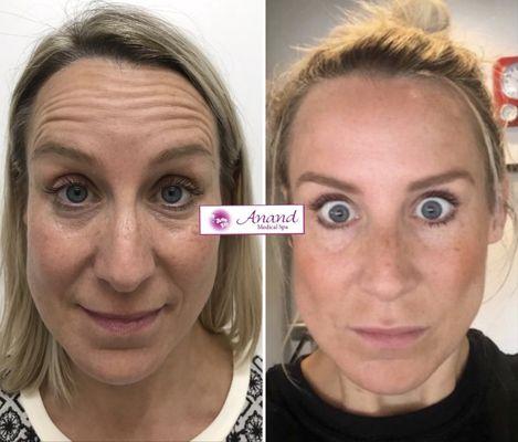 Botox for Forehead lines