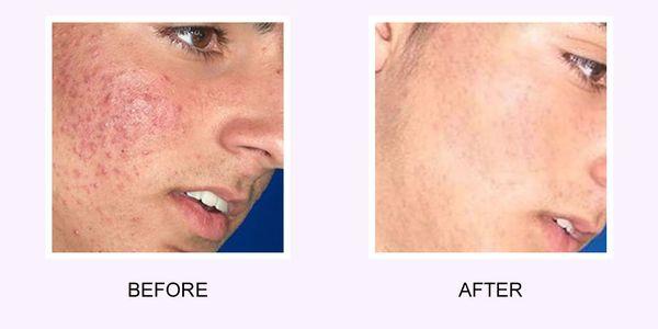 Acne scar reduction