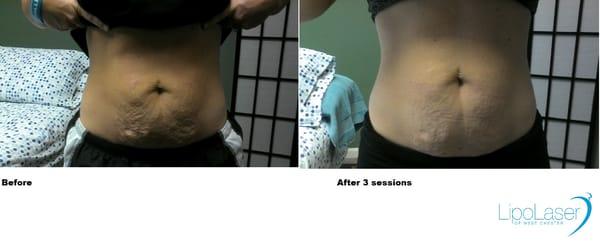 Venus and skin tightening