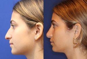 Rhinoplasty