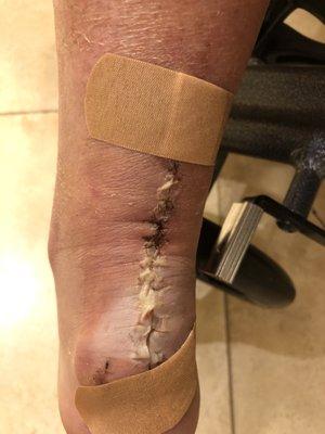 Infected achilles tendon repair