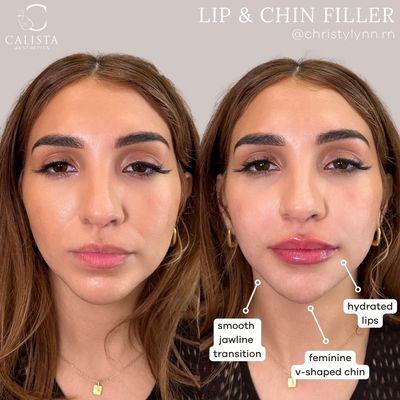 Lip and chin by Christylynn RN