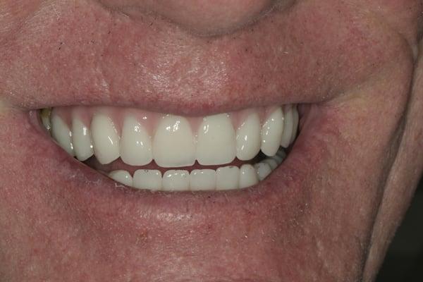 Full upper Hybrid Denture supported by dental implants. This is a non removable prosthesis...