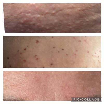 Instantly Remove Spots,growths, moles, warts,milia,etc. Starts at $75