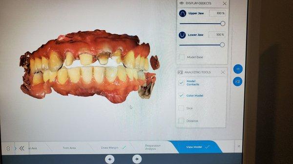 Digital impressions, same day crowns and new technologies for the comfort of our appreciated patients.