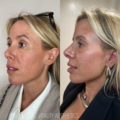 Skinvive skin booster results in the cheeks