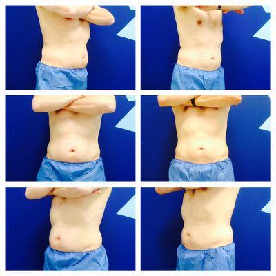 Coolsculpting for our male patients too!