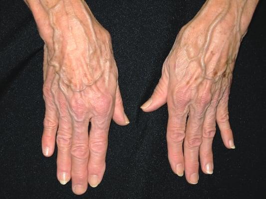 hand veins before treatment