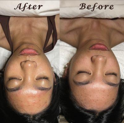 Clarifying Facial Before and After Treatment