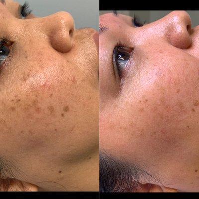 Hyperpigmentation removal