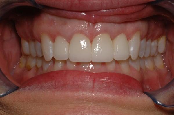 After (4 Upper Veneers)