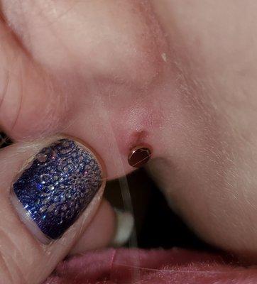 The piercing sunk into this hole that kept getting bigger and was pierced where her ear attaches to her neck