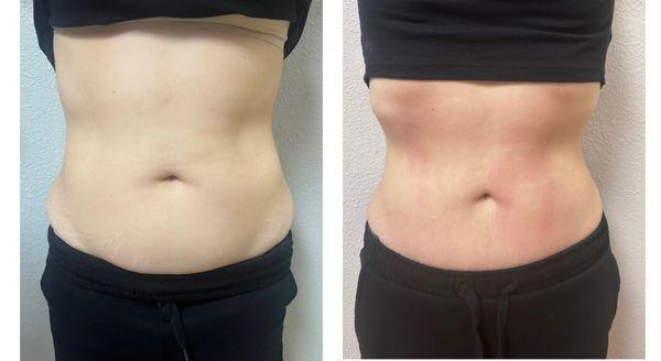 EMS body sculpting results after 4 session.