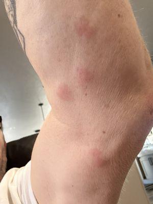 Bug bites from BHCC room 2109 on 3.2.24