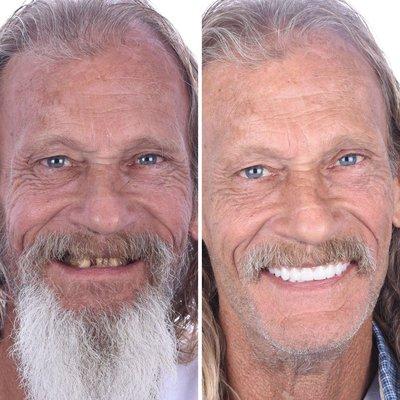 Final results from full mouth dental implants