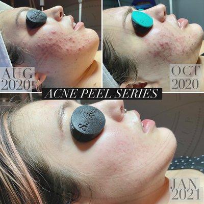 Series of six Peels | Clarify + Refine & Bright Lights treatments 

Mandatory Peel Consultation + Product purchase for results.