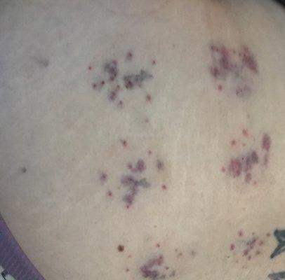 Very painful, burning bruises, after "wet cupping" on my lower back - that I paid an additional $60 for.